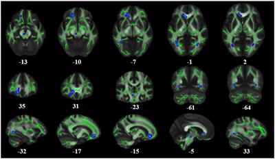 Micro- and macro-changes in early-stage type 2 diabetes mellitus without cognitive impairment: a diffusion tensor imaging (DTI) and surface-based morphometry (SBM) study